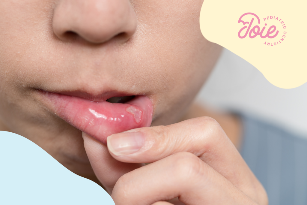 canker sores