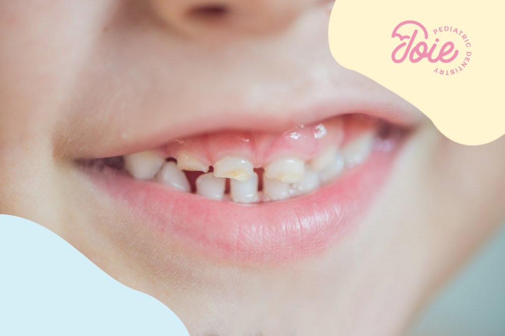 white spots on baby teeth