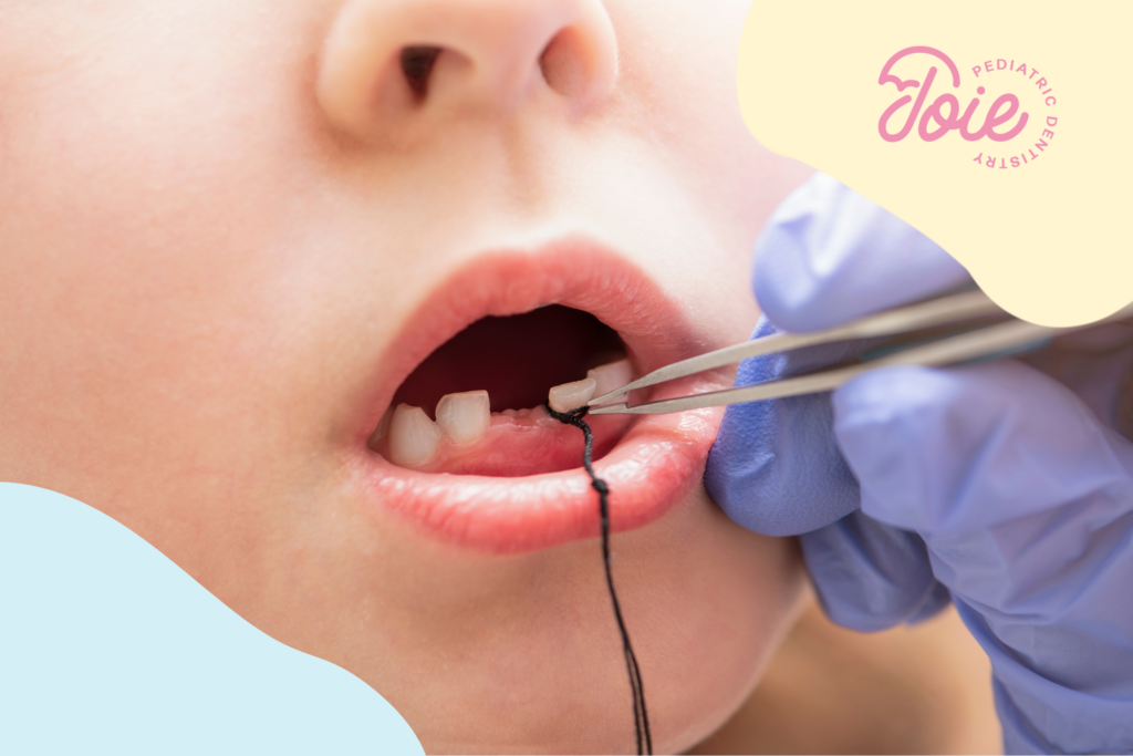 Tooth Extraction for Kids: What to Expect tooth extraction