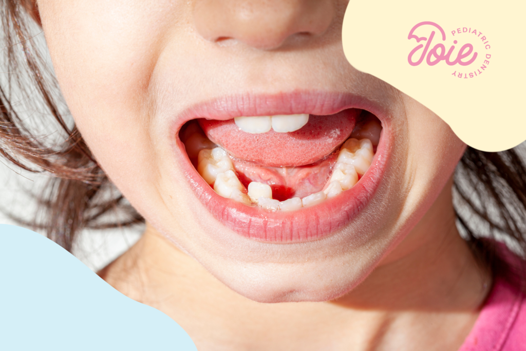 Shark Teeth in Kids: What to Do shark teeth
